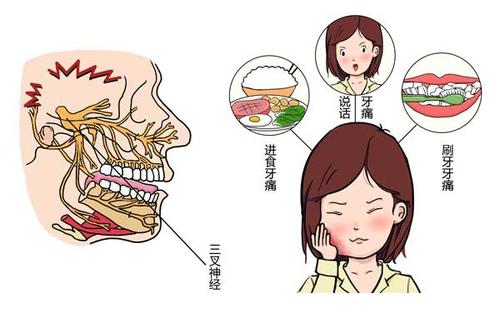 王濤博士的營養(yǎng)素能治三叉神經(jīng)痛嗎？