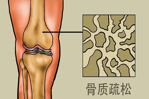 骨質(zhì)疏松有哪些癥狀表現(xiàn)_如何預(yù)防骨質(zhì)疏松呢？