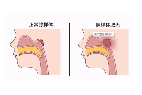 腺樣體肥大孩子睡覺(jué)呼吸困難