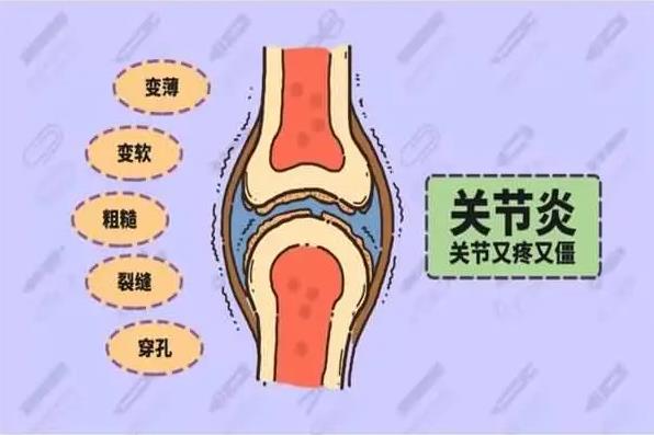 風濕性關節(jié)炎有哪些癥狀表現