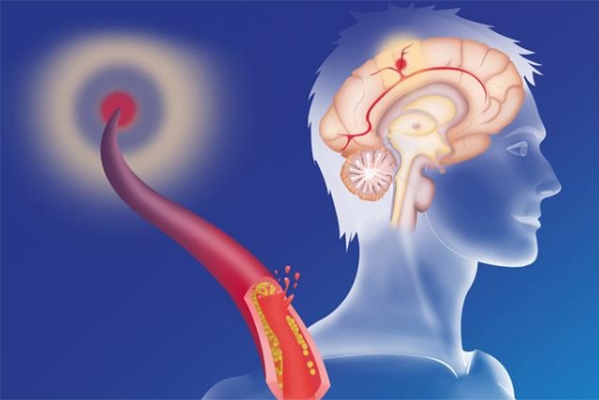 大腦供血不足有哪些癥狀和表現(xiàn)