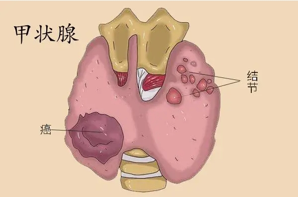 甲狀腺結(jié)節(jié)3類需要治療嗎？